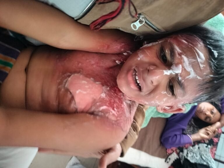 যশোরে গরম পানিতে দগ্ধ শিশু হাসপাতালে ভর্তি