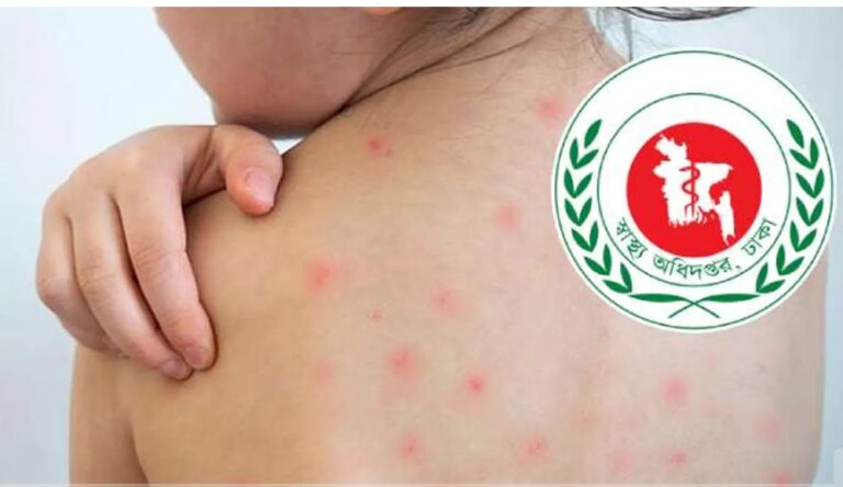 হাম ও উপসর্গে আরও ৫ শিশুর মৃত্যু