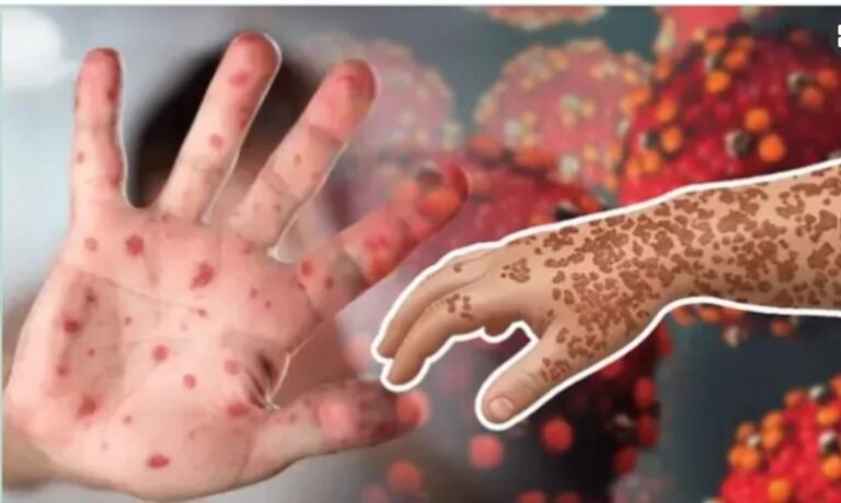২৪ ঘণ্টায় হাম ও উপসর্গে ১১ শিশুর মৃত্যু