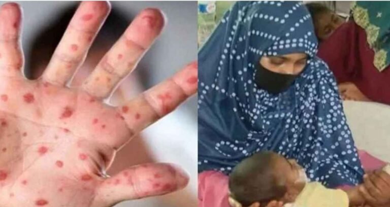 হাম ও হামের উপসর্গ নিয়ে আরও ৩ জনের মৃত্যু